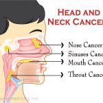 Head and Neck Cancers Are on the Rise and Younger Men Are at Risk